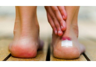 ¿Cómo prevenir las rozaduras?