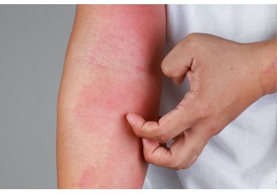 Cómo cuidar la piel atópica: consejos prácticos para calmar, hidratar y proteger la piel sensible Imagen